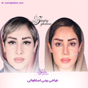 عکس قبل و بعد از جراحی بینی استخوانی - دکتر زرین قلم