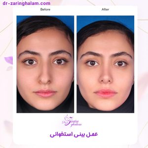 عمل بینی استخوانی در مشهد - دکتر محمدعلی زرین قلم