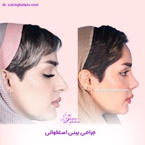 جراحی بینی استخوانی در مشهد - دکتر زرین قلم 