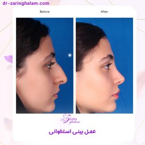 عکس قبل و بعد از جراحی بینی استخوانی - دکتر زرین قلم