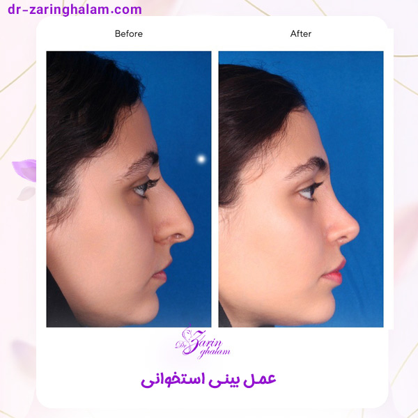 عکس قبل و بعد از جراحی بینی استخوانی - دکتر زرین قلم