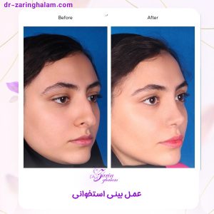 جراحی بینی استخوانی در مشهد - دکتر زرین قلم 