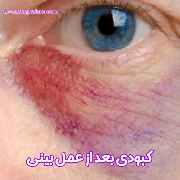 کبودی بعد از عمل بینی - دکتر زرین قلم