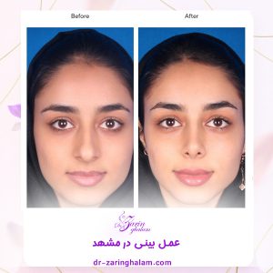 عمل بینی - دکتر زرین قلم 
