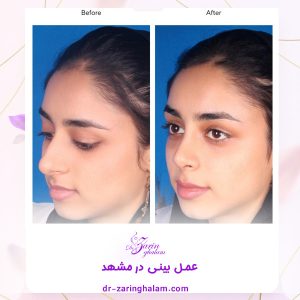 قبل و بعد از بینی - دکتر زرین قلم 