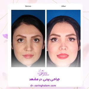 عمل بینی - دکتر زرین قلم 