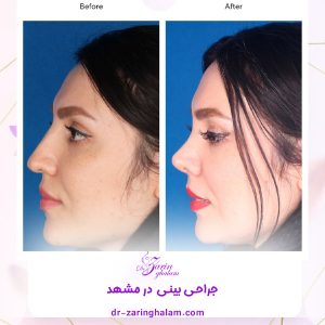 قبل و بعد از جراحی بینی - دکتر زرین قلم 