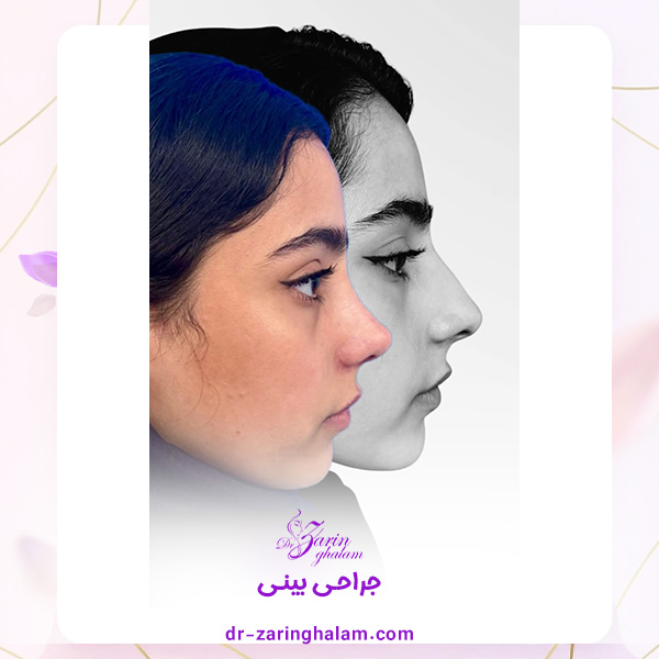 جراحی بینی - دکتر زرین قلم