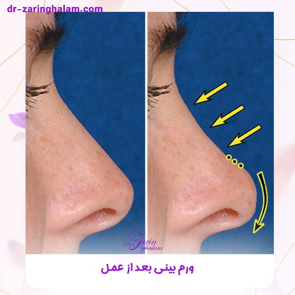 ورم بینی بعد از عمل - دکتر زرین قلم