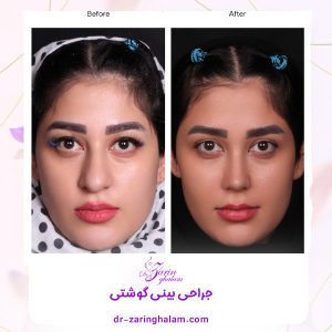 عکس قبل و بعد از عمل بینی گوشتی - دکتر زرین قلم 