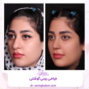 عکس قبل و بعد از عمل بینی گوشتی - دکتر زرین قلم 