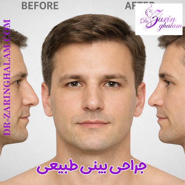 جراحی بینی طبیعی در مشهد - دکتر زرین قلم
