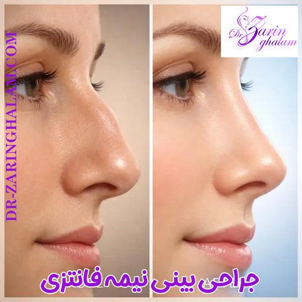 جراحی بینی نیمه فانتزی - دکتر زرین قلم
