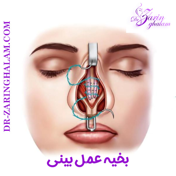 بخیه عمل بینی - دکتر زرین قلم