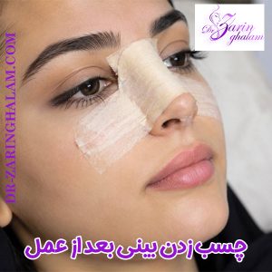 چسب زدن بینی بعد از عمل - دکتر زرین قلم