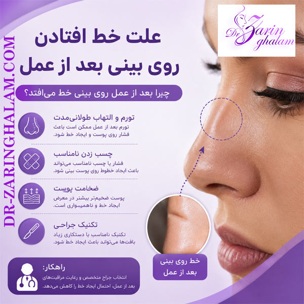 خط افتادن روی بینی بعد از عمل - دکتر زرین قلم