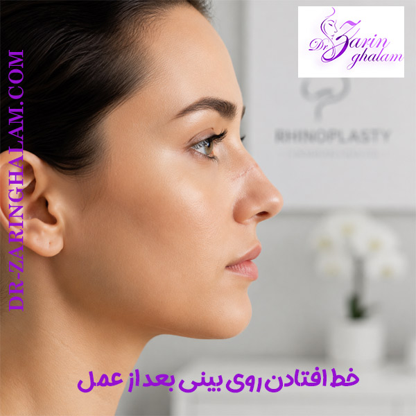 خط افتادن روی بینی بعد از عمل - دکتر زرین قلم